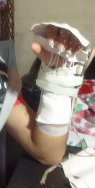 Bastida's left hand after injury. Photo credit: Lucas Bastida
